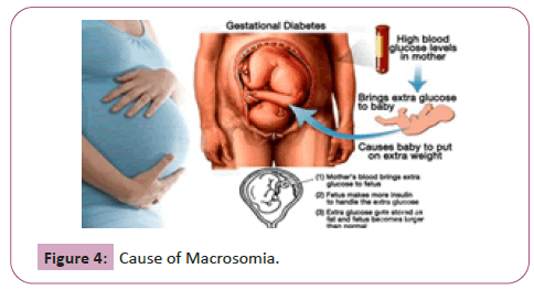 endocrinology-metabolism-Macrosomia