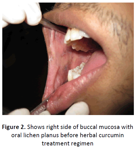 ethnomedicine-buccal-lichen-planus