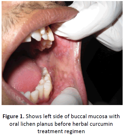 ethnomedicine-buccal-mucosa-planus