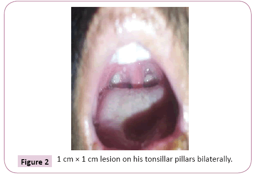 ethnomedicine-tonsillar