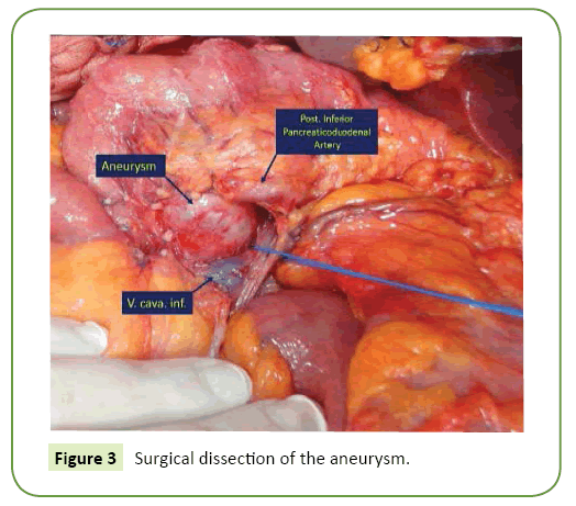 general-surgery-reports-aneurysm