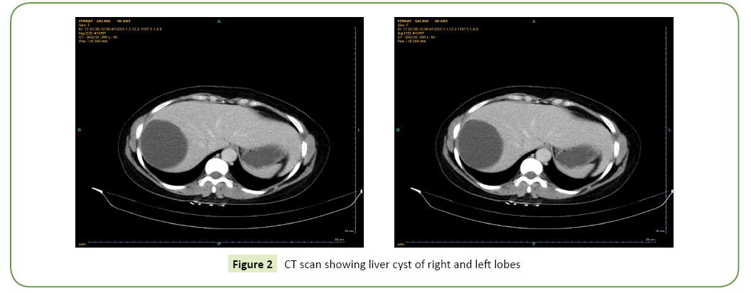 general-surgery-reports-cyst