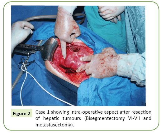 general-surgery-reports-hepatic