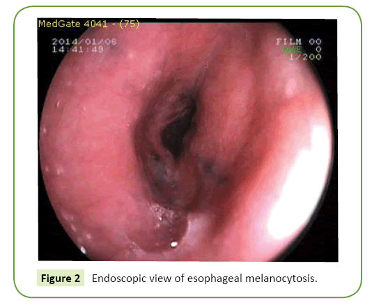 general-surgery-reports-melanocytosis