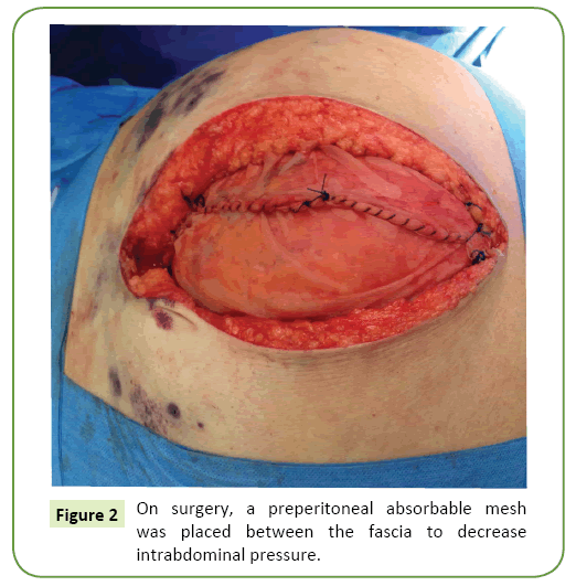 general-surgery-reports-preperitoneal