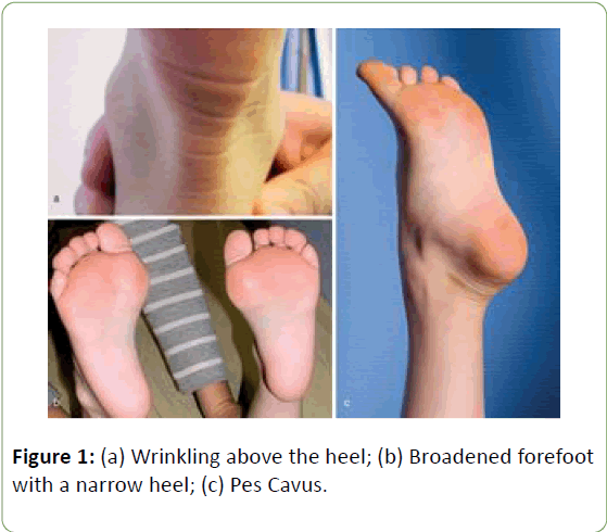 genetics-molecular-biology-Broadened-forefoot