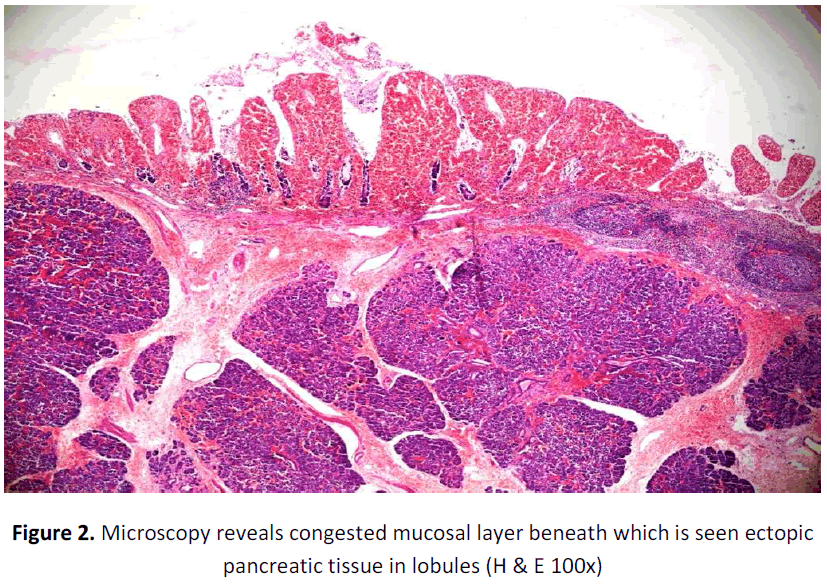 global-journal-of-research-and-review-microscopy-mucosal-ectopic