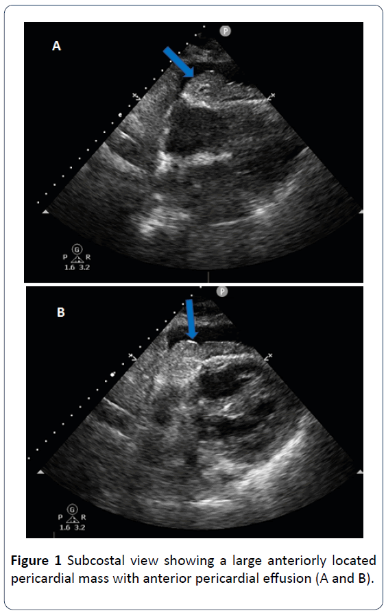 heart-cardiovascular-research-subcostal-view-large