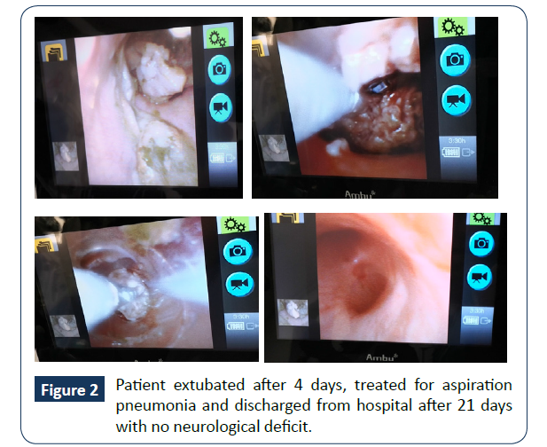 hospital-medical-management-extubated