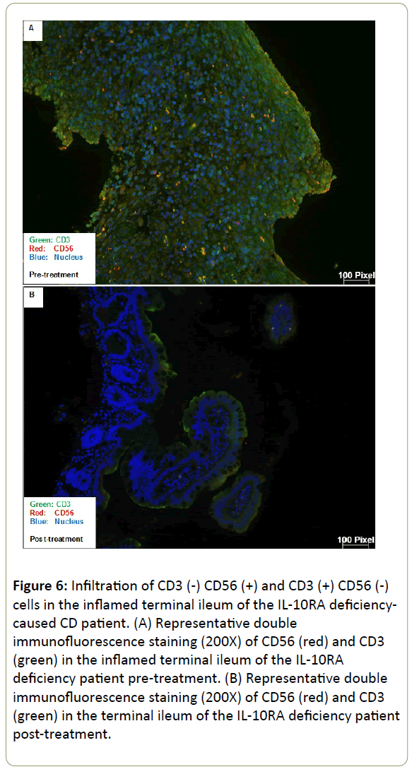 immunology-immunotherapy-inflamed-terminal-ileum