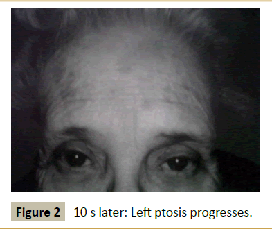 insights-in-ophthalmology-Left-ptosis