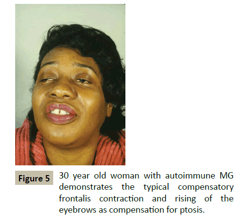 insights-in-ophthalmology-contraction-frontalis