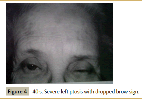 Figure 4:40 s: Severe left ptosis with dropped brow sign. 