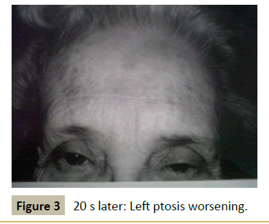 insights-in-ophthalmology-ptosis-worsening