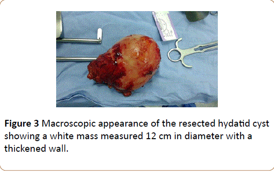 insights-in-reproductive-medicine-hydatid-cyst