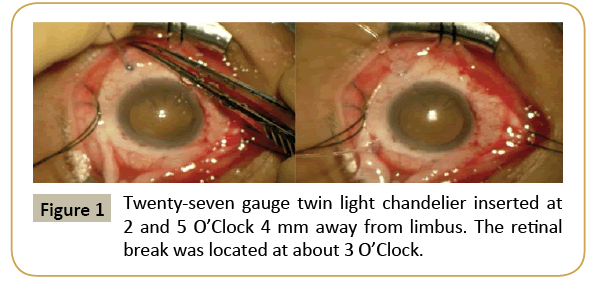 insights-ophthalmology-chandelier-inserted