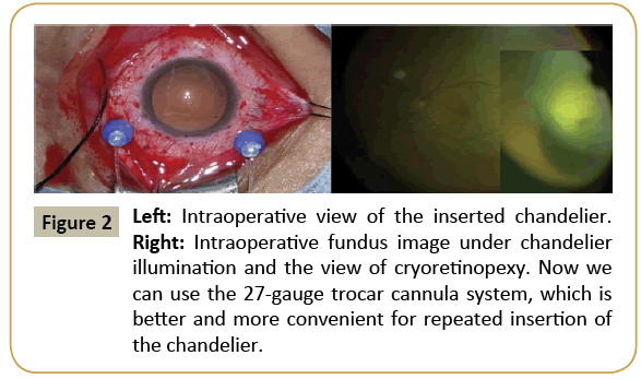 insights-ophthalmology-cryoretinopexy