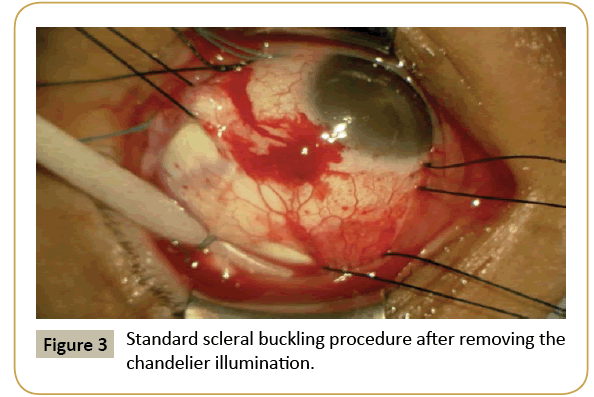 insights-ophthalmology-scleral-buckling