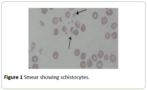 integrative-journal-global-health-schistocytes