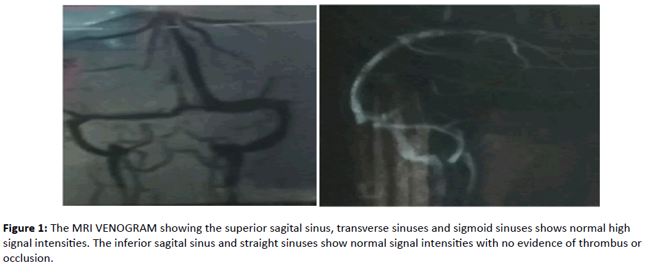 international-journal-MRI-VENOGRAM