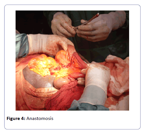 international-journal-case-reports-Anastomosis