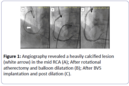international-journal-case-reports-Angiography-revealed