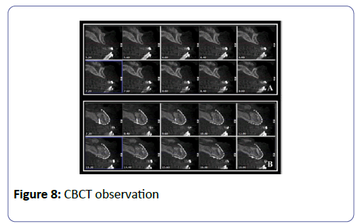 international-journal-case-reports-CBCT-observation