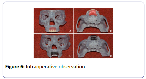 international-journal-case-reports-Intraoperative