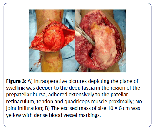 international-journal-case-reports-Intraoperative-pictures