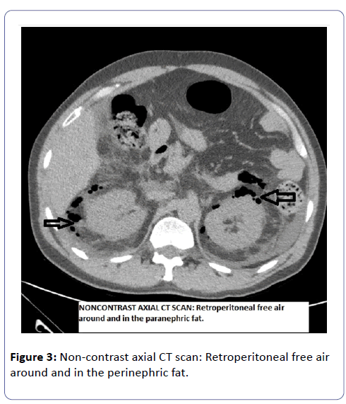 international-journal-case-reports-Retroperitoneal-free