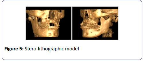 international-journal-case-reports-Stero-lithographic