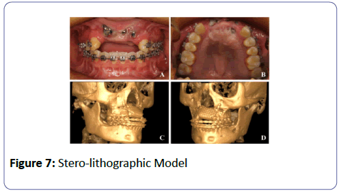 international-journal-case-reports-Stero-lithographic