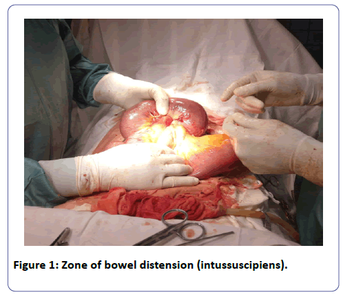 international-journal-case-reports-Zone-bowel