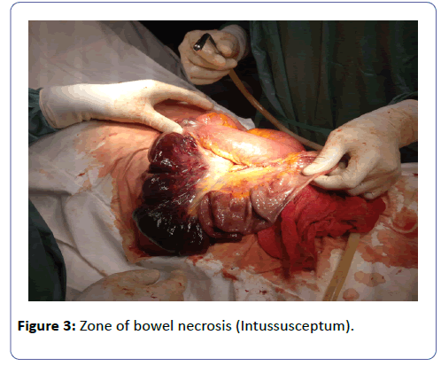 international-journal-case-reports-Zone-bowel