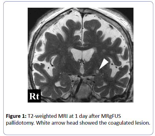 international-journal-case-reports-coagulated-lesion