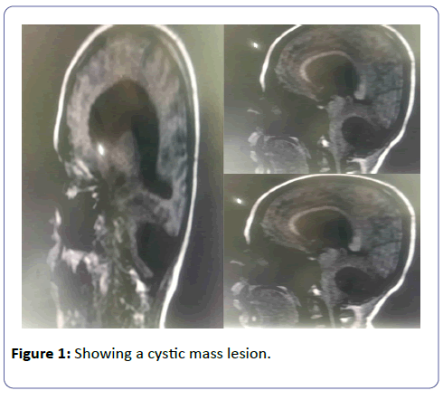 international-journal-case-reports-cystic-mass