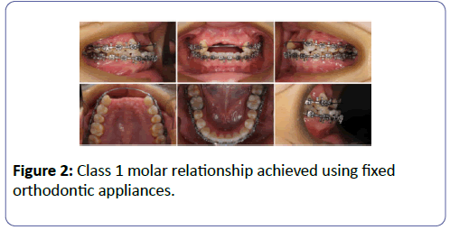 international-journal-case-reports-molar-relationship