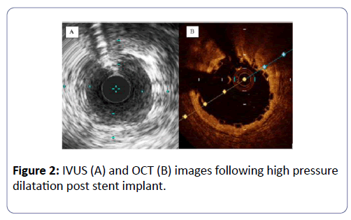 international-journal-case-reports-stent-implant