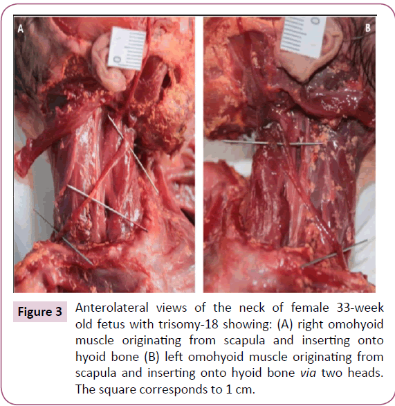 journal-anatomical-science-research-hyoid-bone