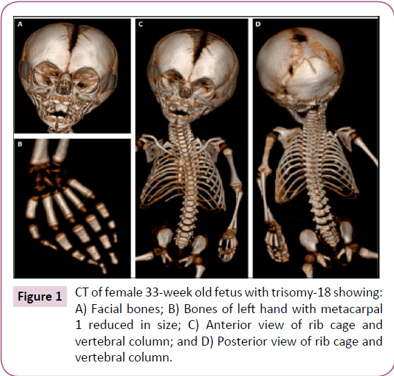 journal-anatomical-science-research-old-fetus