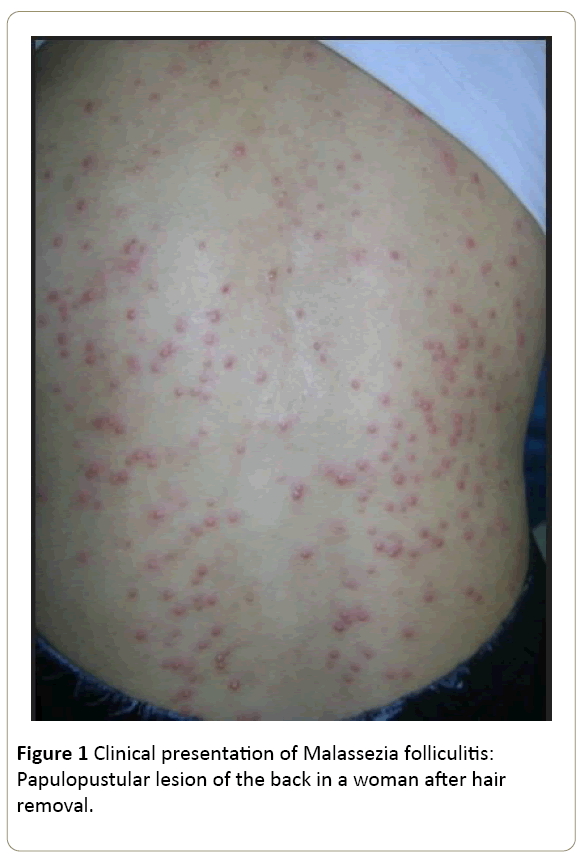 Malassezia Folliculitis Treatment