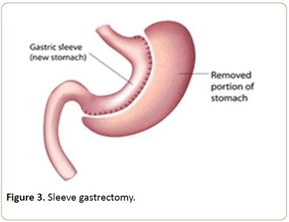 journal-metabolism-Sleeve-gastrectomy