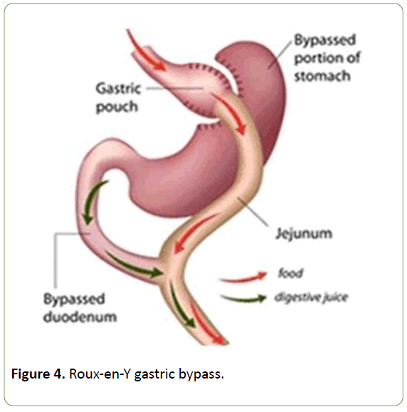 journal-metabolism-gastric-bypass