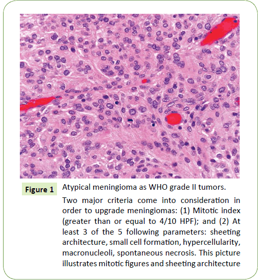 medical-oncology-meningioma