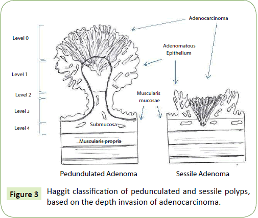 medical-oncology-pedunculated