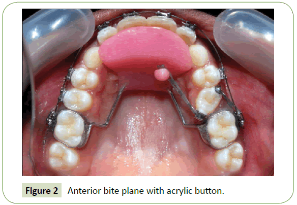 medical-research-health-education-Anterior-bite-plane