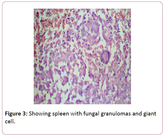 medicine-therapeutics-fungal-granulomas