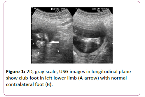 Antenatal 3d Usg In Unilateral Club Foot A Rare Anomaly Insight Medical Publishing