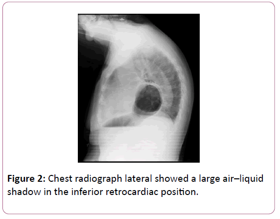 medicine-therapeutics-retrocardiac-position