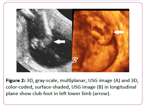 Antenatal 3d Usg In Unilateral Club Foot A Rare Anomaly Insight Medical Publishing